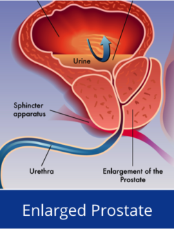 Enlarge Prostate