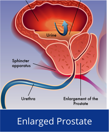 Enlarge Prostate