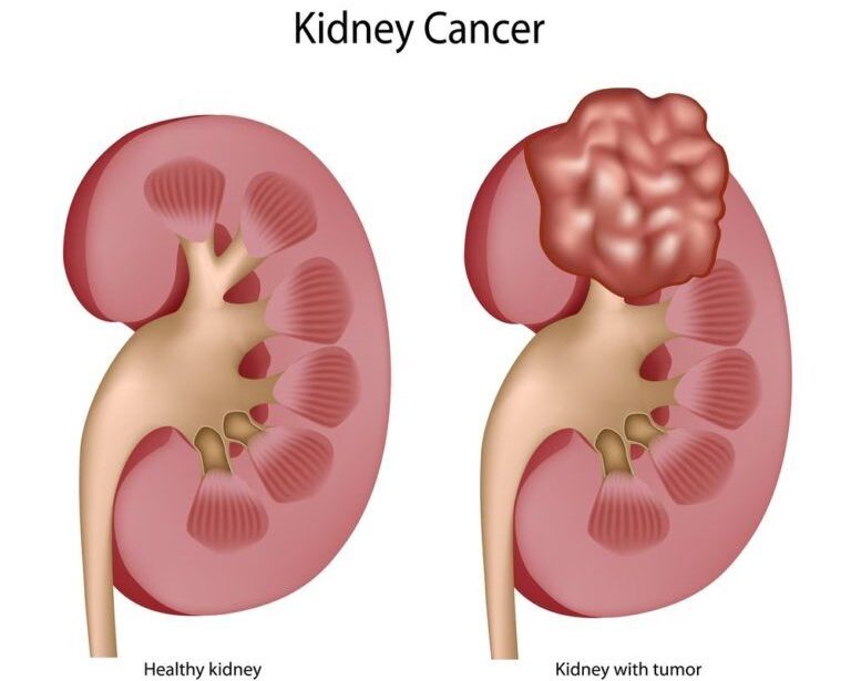 Kindney Cancer