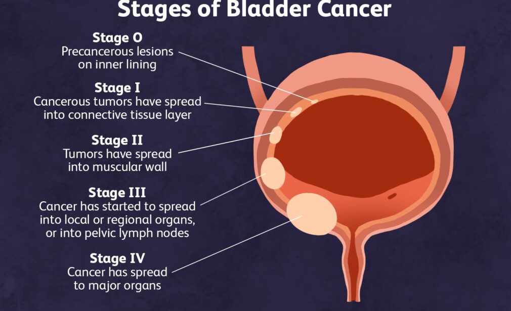 Urinary Bladder Cancer