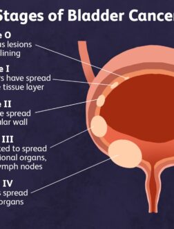 Urinary Bladder Cancer