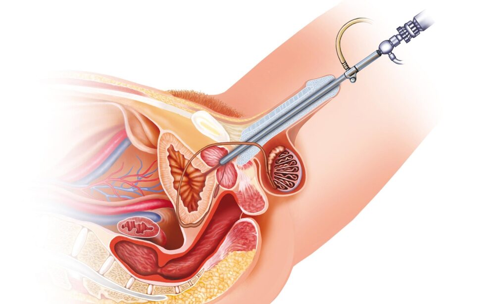 urethral-stricture-treatment