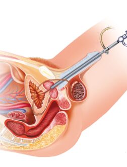 urethral-stricture-treatment